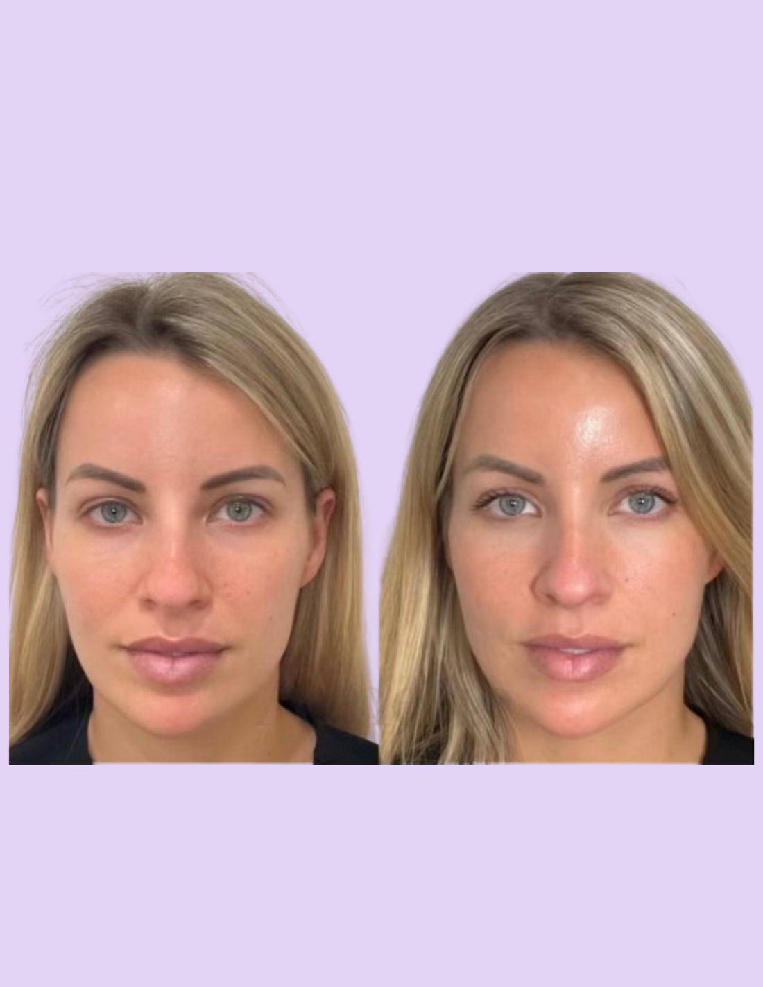 Sculptra: The Future of Injectables